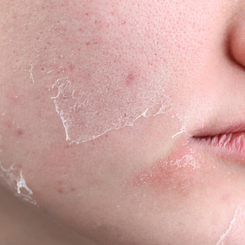 Peau déshydratée à Lausanne Peau déshydratée à Lausanne