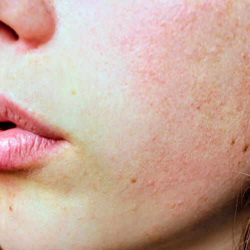 Peau à texture irrégulière à Lausanne