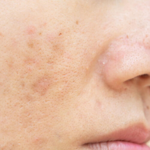 Taches pigmentaires à Lausanne